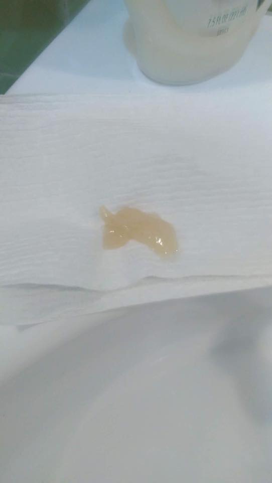 mucus plug falling out